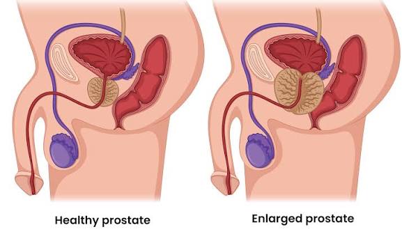 Understanding Enlarged Prostate: Symptoms & Solutions